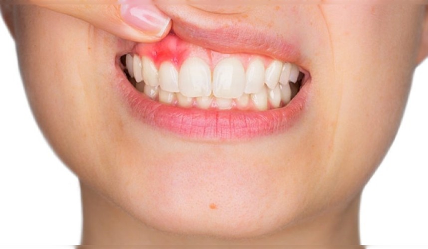 Periodontoloji (Diş Eti Hastalıkları)