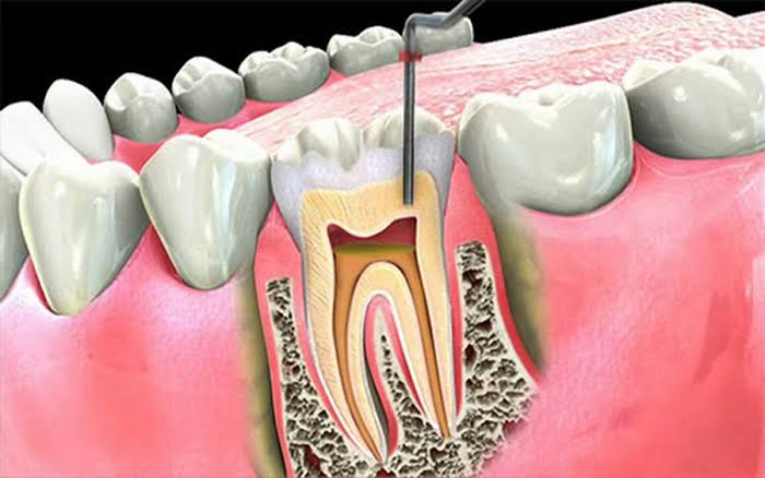Endodonti (Kanal Tedavisi)